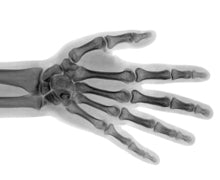 Probiotics Shown to Increase Bone Density