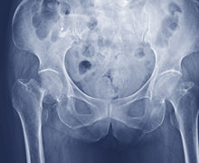 More Vitamin K means Fewer Broken Bones